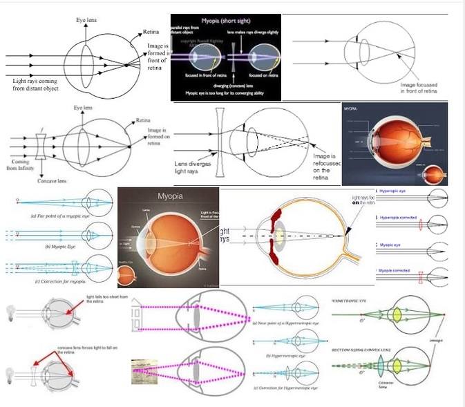 myopia diagram