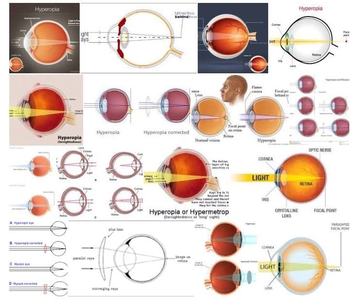 hyperopic diagram