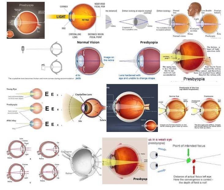 presbyopia diagram