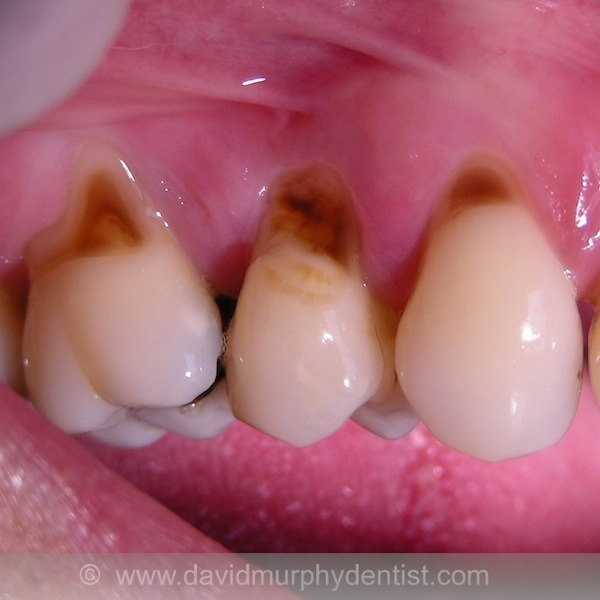 Cervical cavities