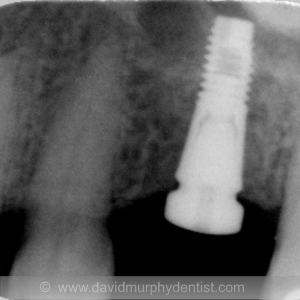 Implant 2 after