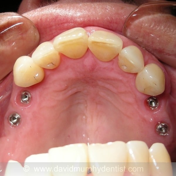 Implant 6 before