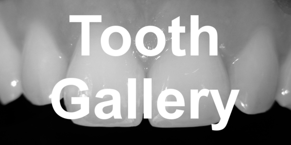 Tooth Gallery