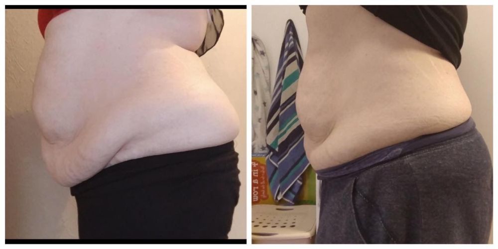 Fat Dissolving Injections