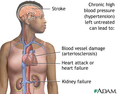 untreated-hypertension-picture