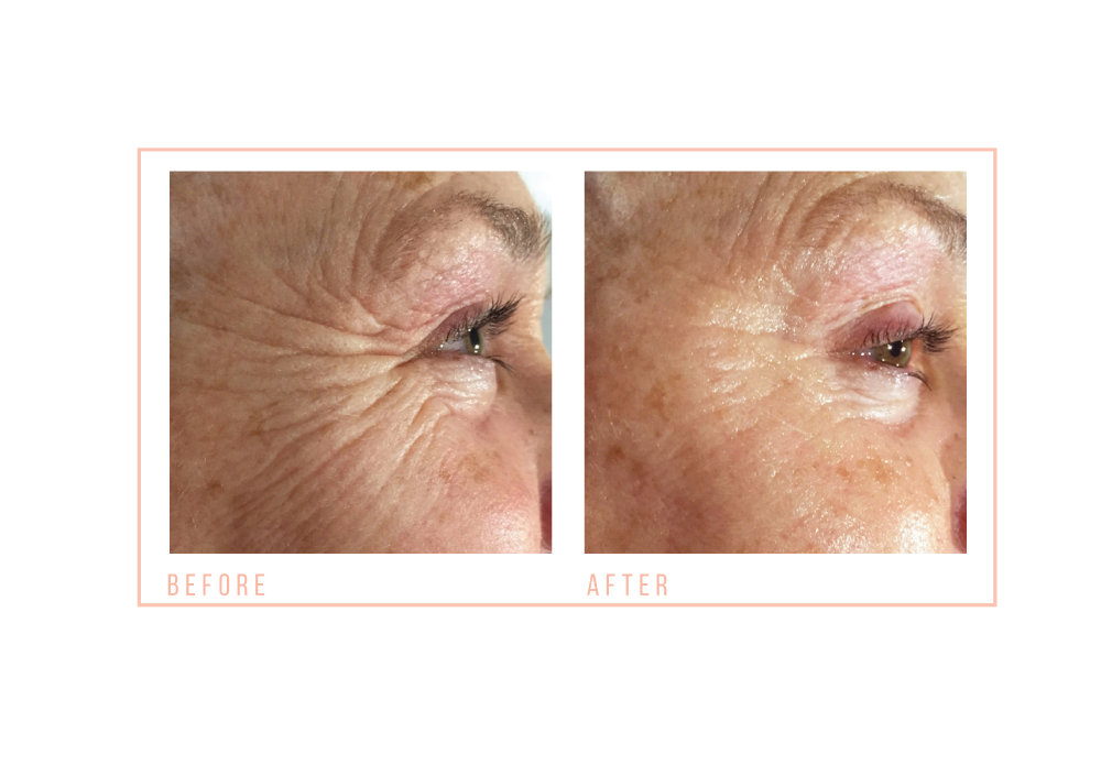 before and after Eye Revive