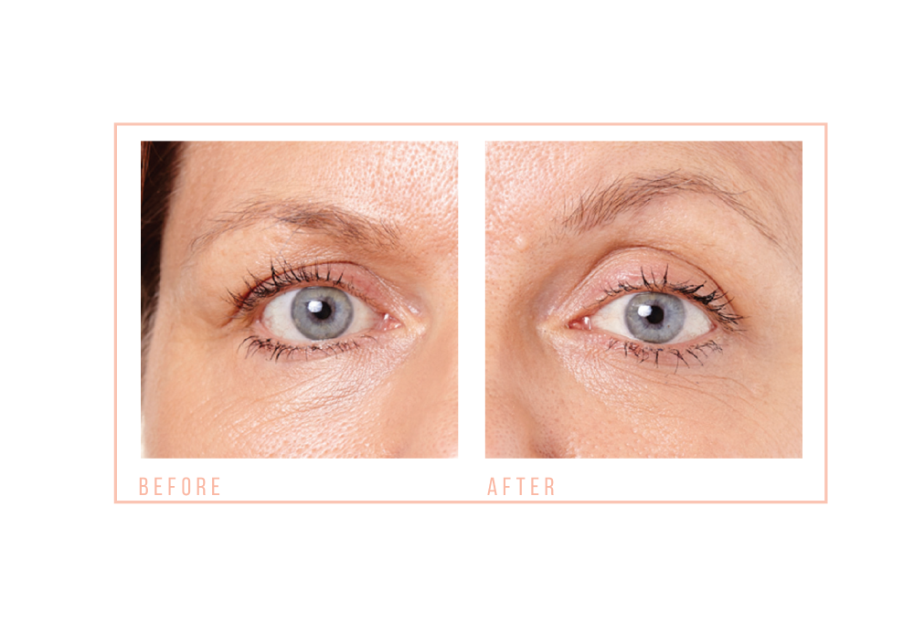 Before and After Eye Revive (1)