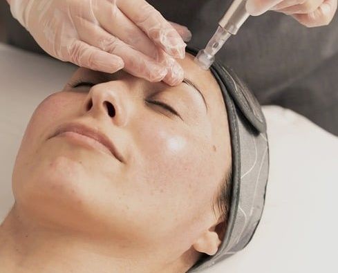 Diamond Microdermabrasion (Electrical Facial)