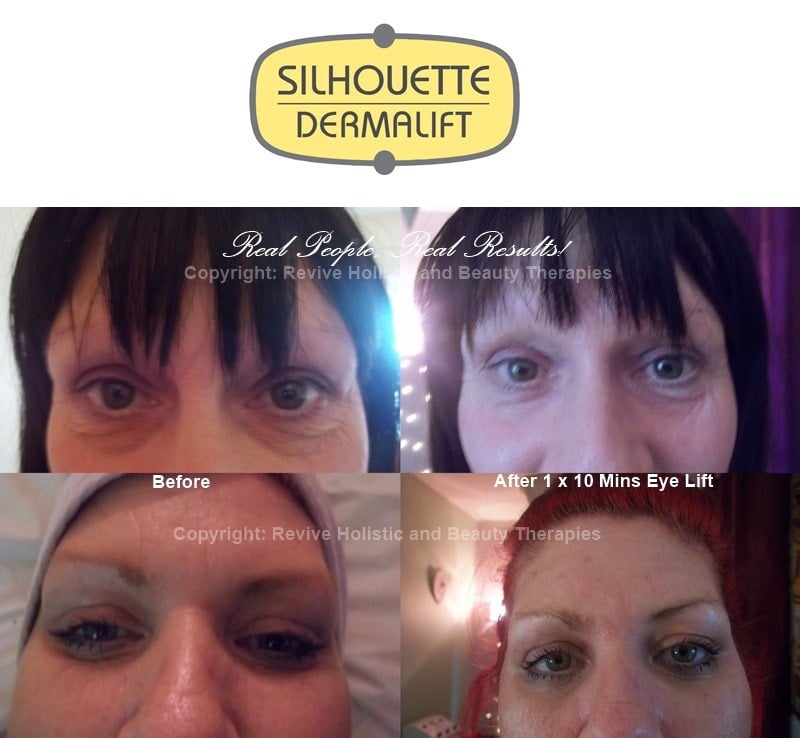 dermalift eye before and after combo