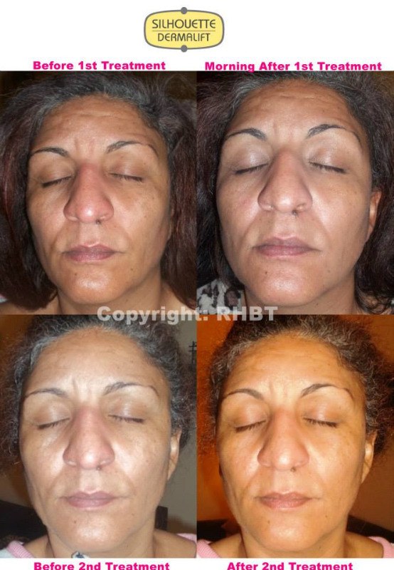 Dermalift Microcurrent Non Surgical Face Lifts in Stockport