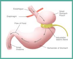 gastric band