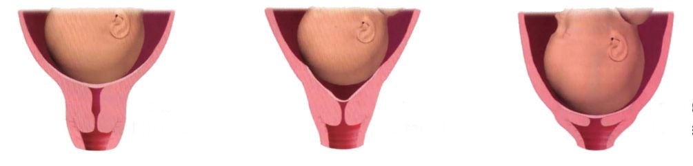 cervix effacement