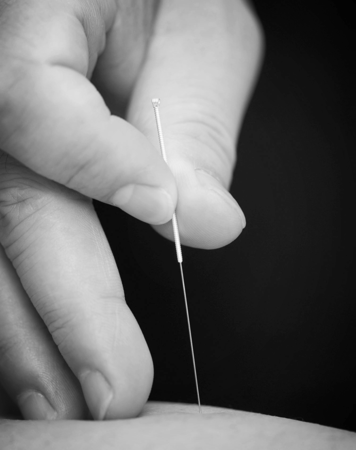 effective dry needling or medical acupuncture for the treatment of chronic pain, referred pain