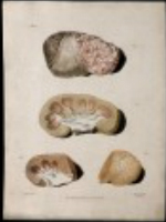 four sections of diseased kidney 2