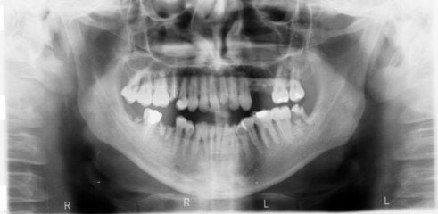 broken-tooth-radiography-1558768