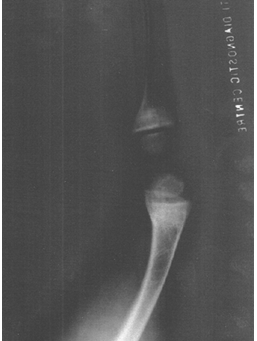 Rickets.Xray