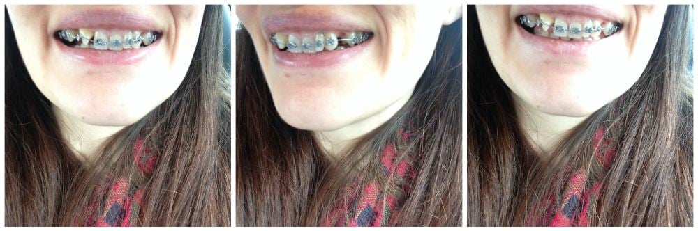 braces at 30 – i had my top brace fitted! photo