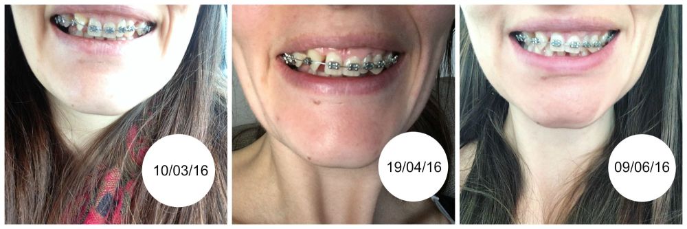 Three month progress braces 30 teeth blog post lylia rose