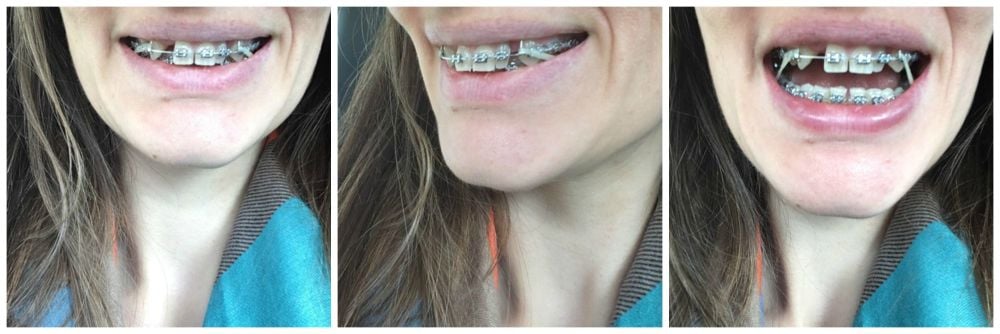 Braces in my 30s blog experience tightening elastics top to bottom