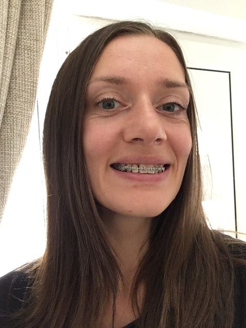 Braces at 30:  My 11th Appointment closing gaps and improving overbite