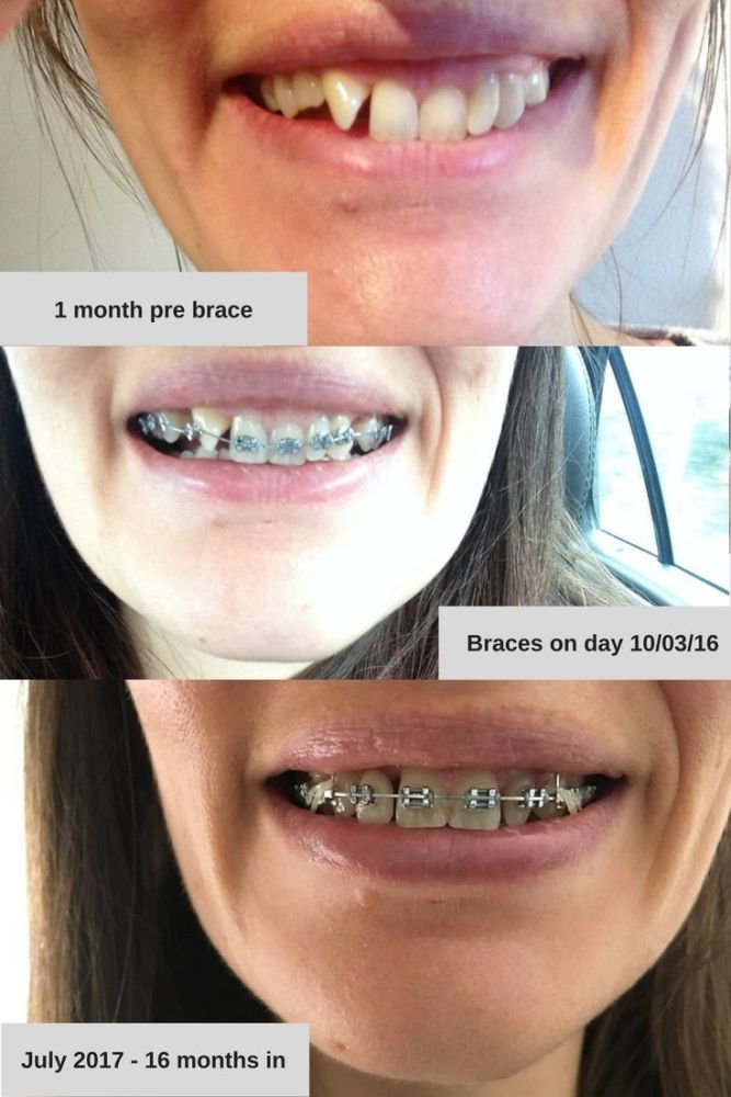 16 months with an adult brace before and after photos timeline