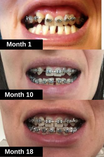Braces Timeline Before and After My 12th tightening appointment update 18 m