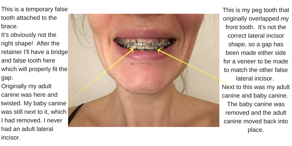 22 month adult traintrack metal brace update false teeth peg tooth wire fix