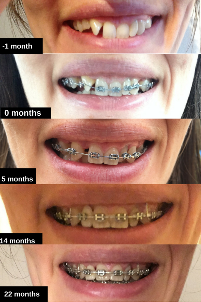 22 months brace timeline before and after photos adult experience wire trai