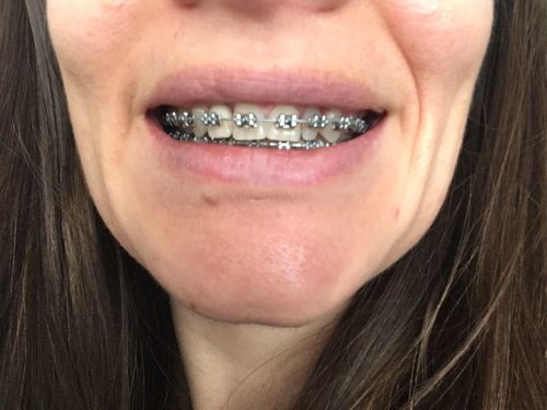 Braces at 30 15th Tightening 23 Months Before and After Photos