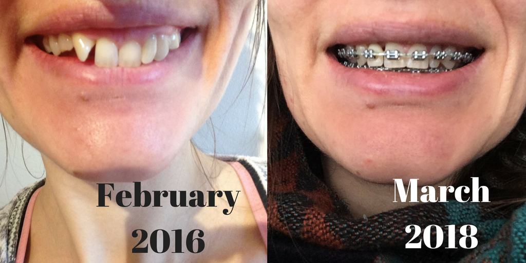 teeth braces march 2018 before and after photos 2 years