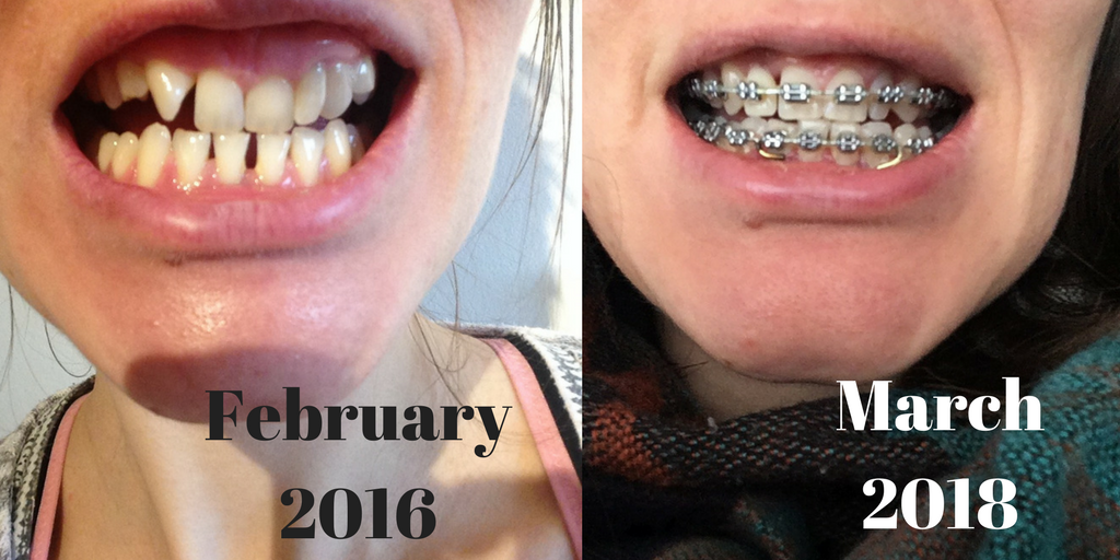 teeth braces march 2018 before and after photos 2 years (1)
