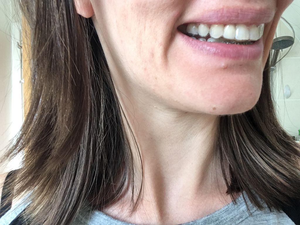 My Adult Essix Retainer Fitting and Photos with False Tooth Peg Tooth