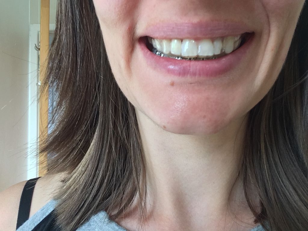 My Adult Essix Retainer Fitting and Photos with False Tooth