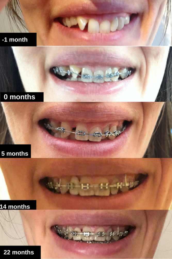 22 months brace timeline before and after photos adult experience wire trai