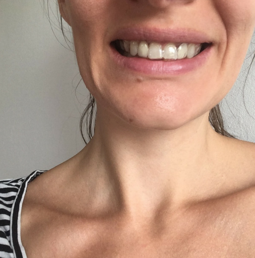 NO MORE BRACES AFTER 28 MONTHS (BUT ITS NOT OVER YET) - orthodontics at 30
