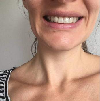 NO MORE BRACES AFTER 28 MONTHS (BUT ITS NOT OVER YET) - orthodontics at 30