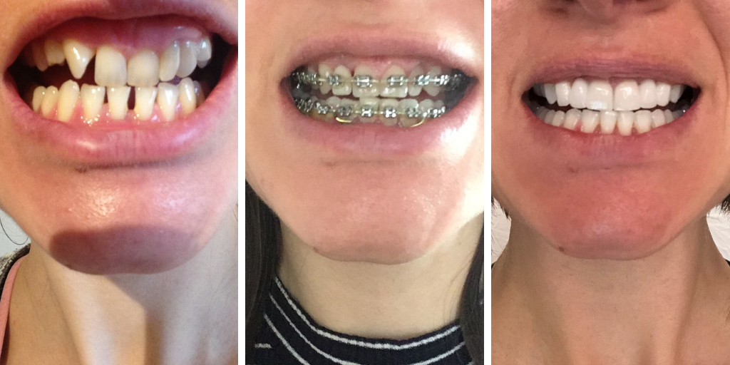 Adult braces, train tracks, bridges, cosmetic bonding, whitening, before af