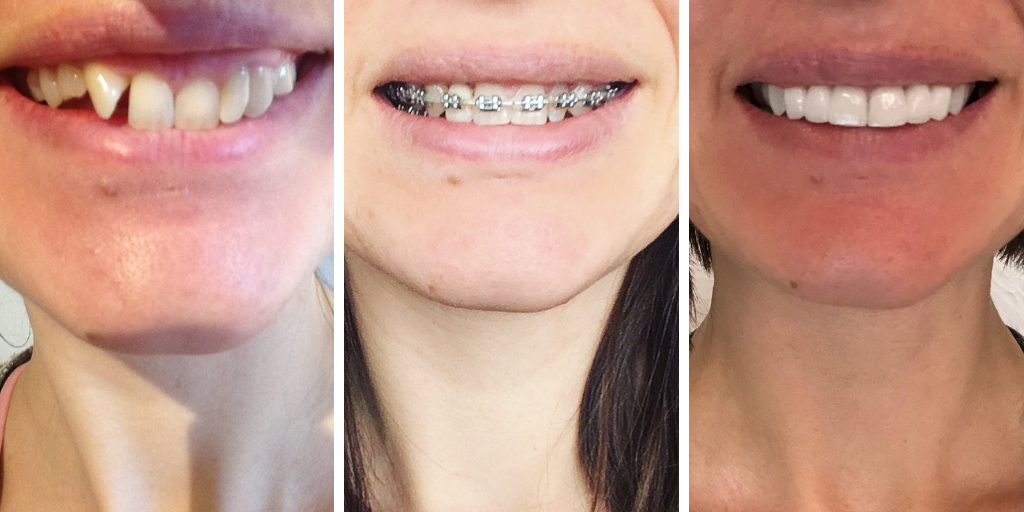 Adult braces, train tracks, bridges, cosmetic bonding, whitening, before af