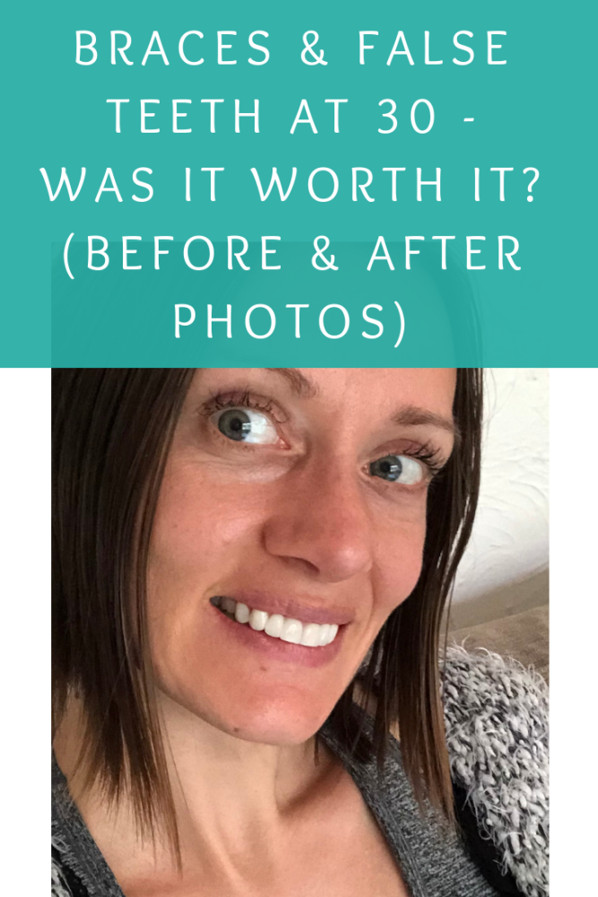 Braces and false teeth at 30&ndash; My teeth are done! Was it worth it_