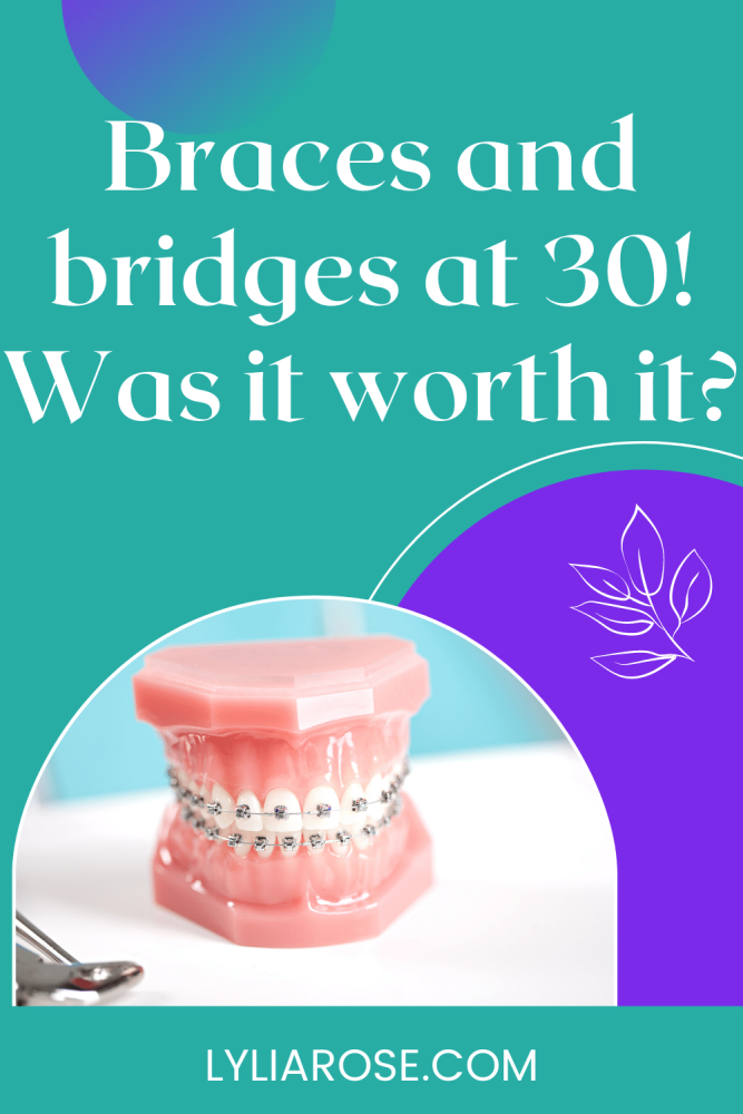 braces bridges adult 30 before after final results
