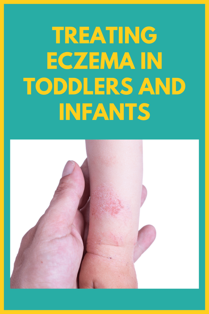 Treating eczema in toddlers and infants