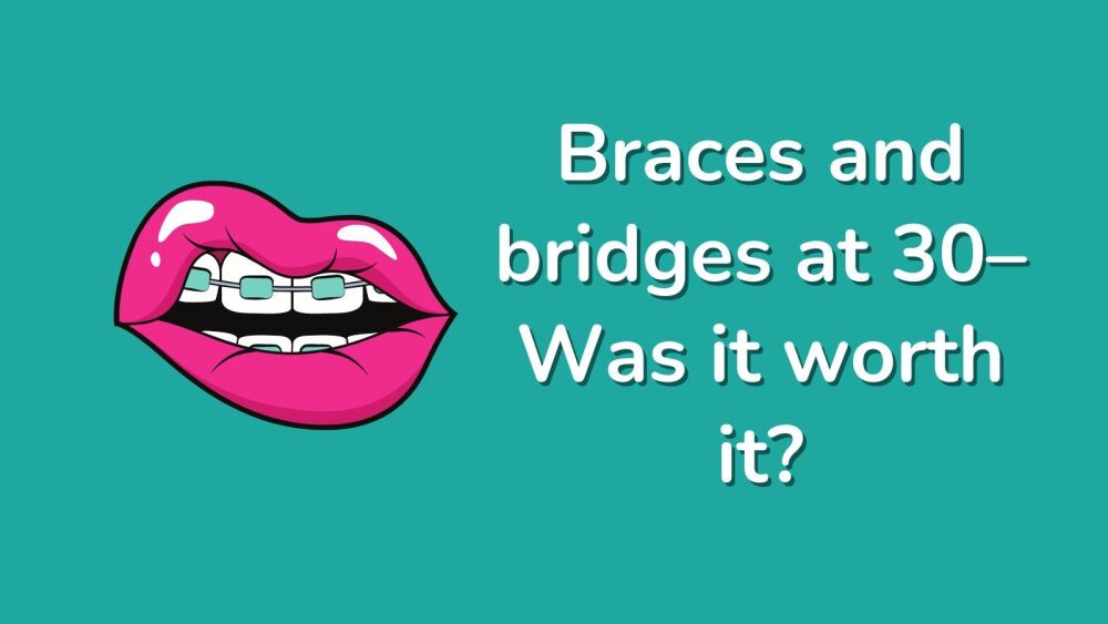 Braces and bridges at 30&ndash; Was it worth it