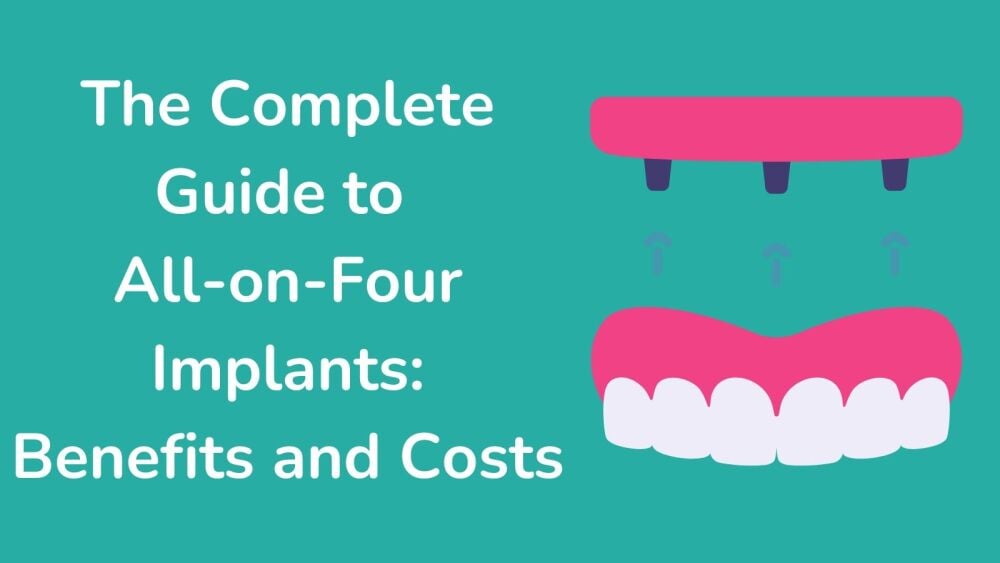 The Complete Guide to All-on-Four Implants Benefits and Costs
