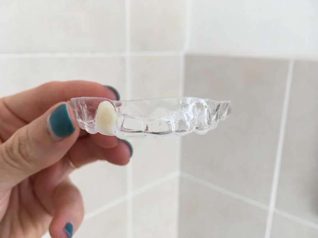Essix retainer side view with false tooth