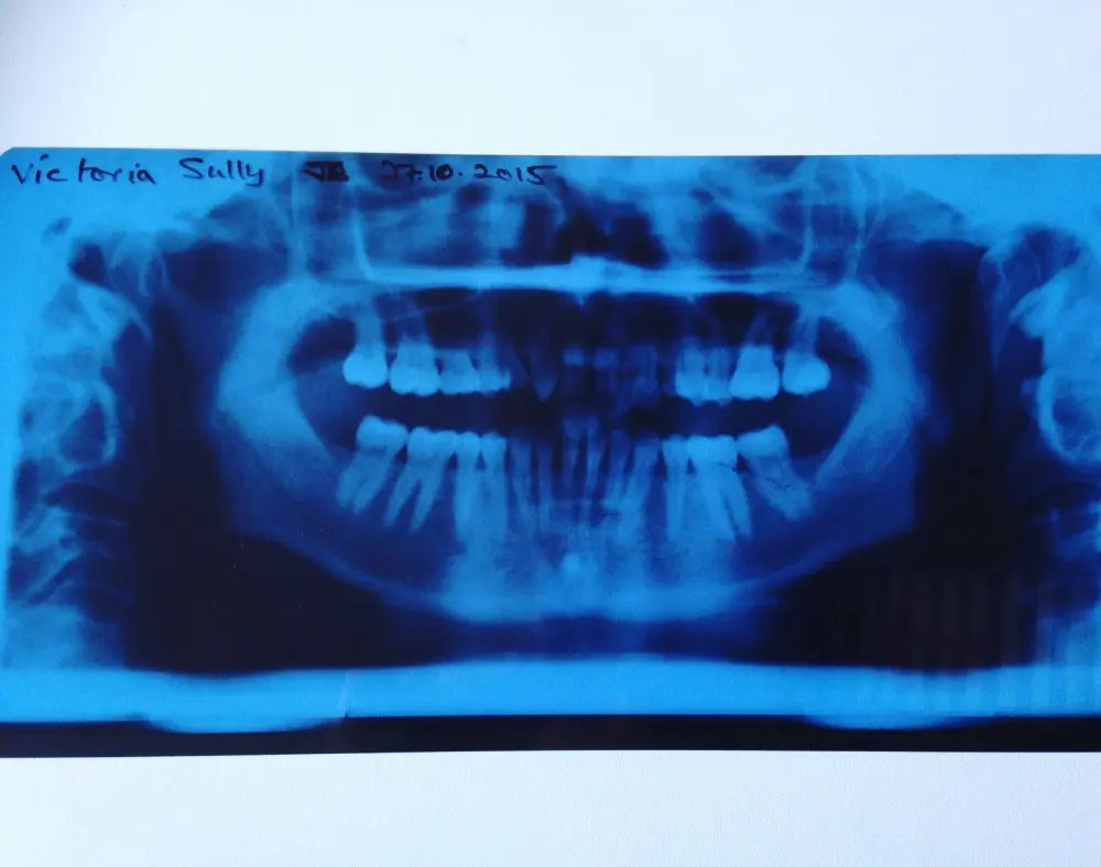 xray before braces at 30 xray before braces at 30