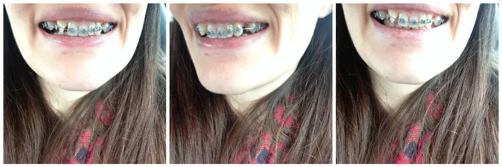 Top brace just fitted - March 2016 - it begins braces at 30 Top brace just fitted - March 2016 - it begins braces at 30