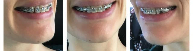 adult braces at 30 elastics top to bottom adult braces at 30 elastics top to bottom