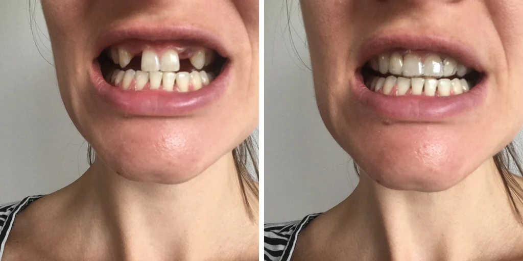 essix retainer with false teeth before and after