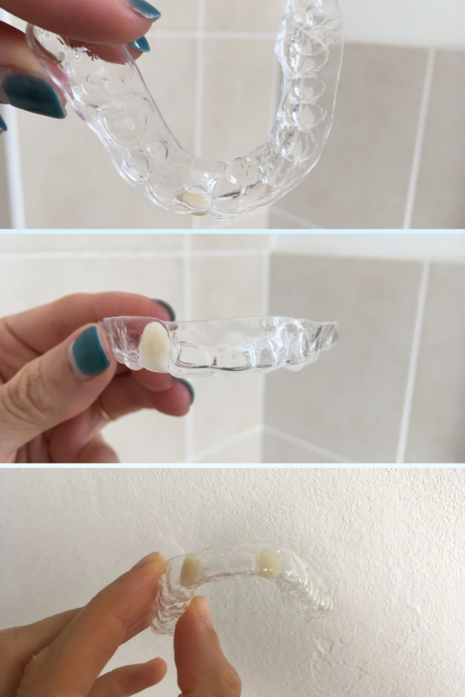 12 Reasons I Hate the Clear Plastic Essix Retainer (2)