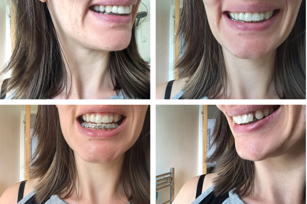 12 Reasons I Hate the Clear Plastic Essix Retainer (3)